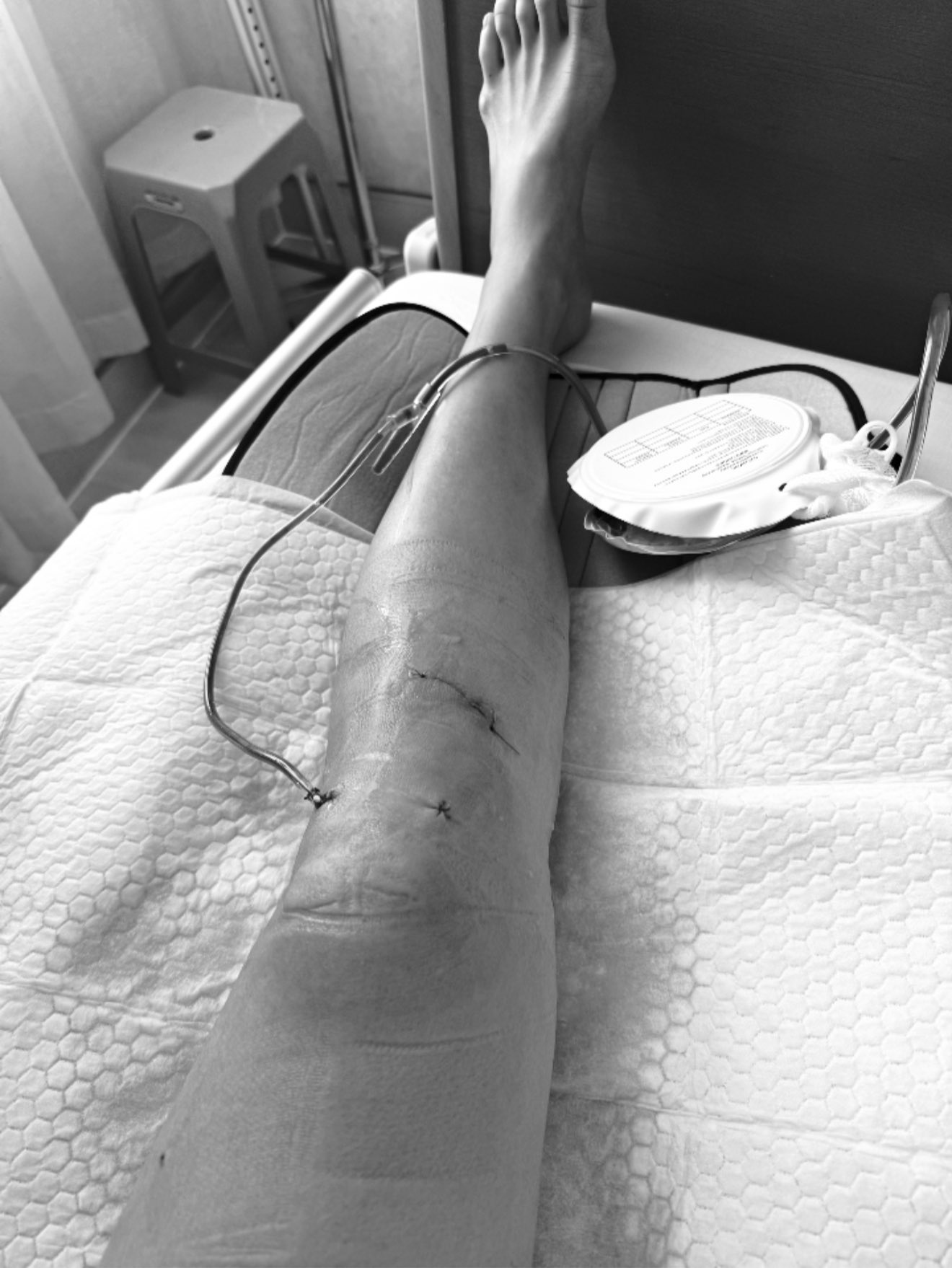 Minh Tú sốc vì chấn thương nghiêm trọng