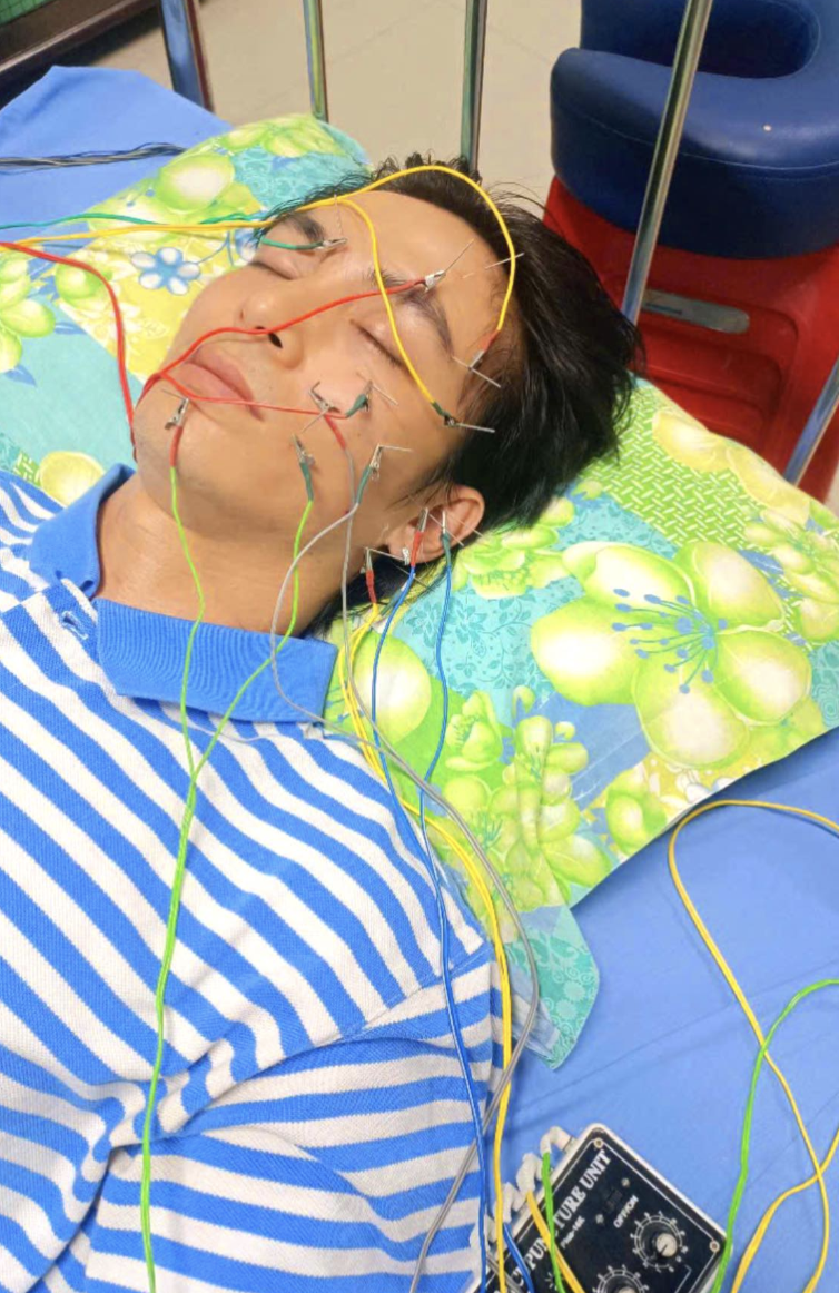 Hình ảnh khuôn mặt Lãnh Thanh lúc bị liệt dây thần kinh số 7