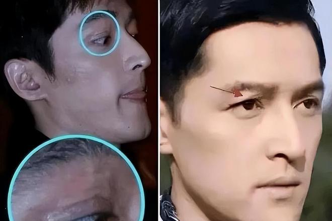 Vết sẹo trên mặt Hồ Ca do vụ tai nạn năm xưa