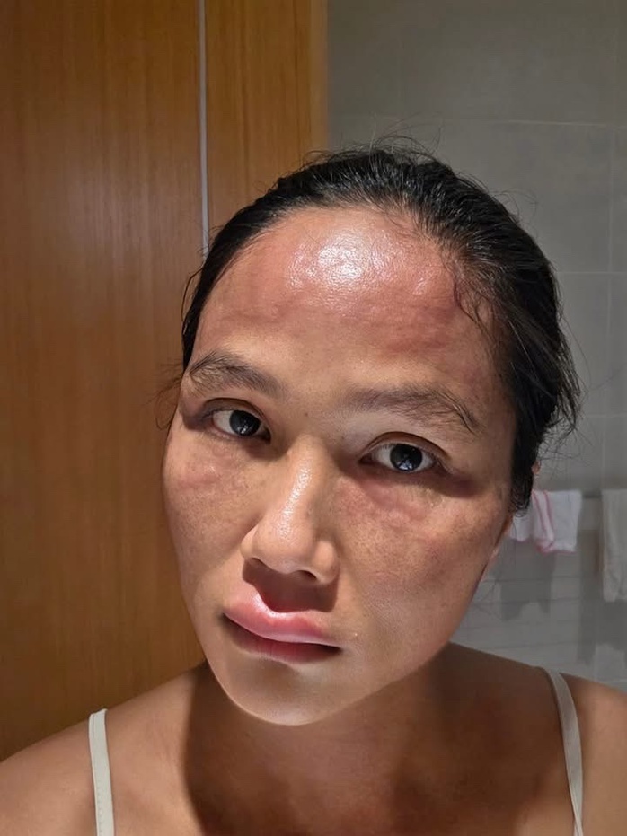 H'Hen biến dạng vì bệnh mề đay