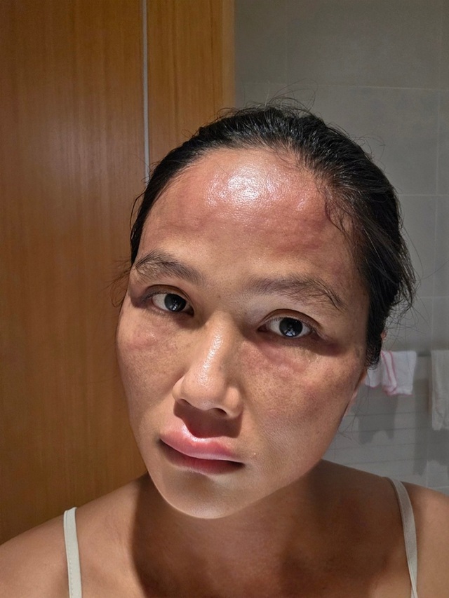 Hoa hậu H'Hen Niê sau khi bị biến dạng mặt - Ảnh 2. H'Hen Niê mặt sưng đỏ